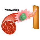 blog pyomyositis 142x142